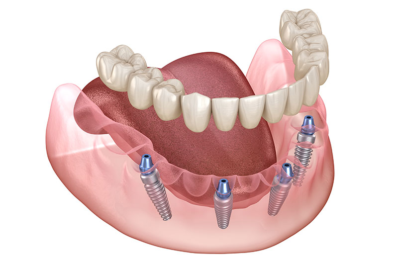 All on 4 Dental Implants in Orlando