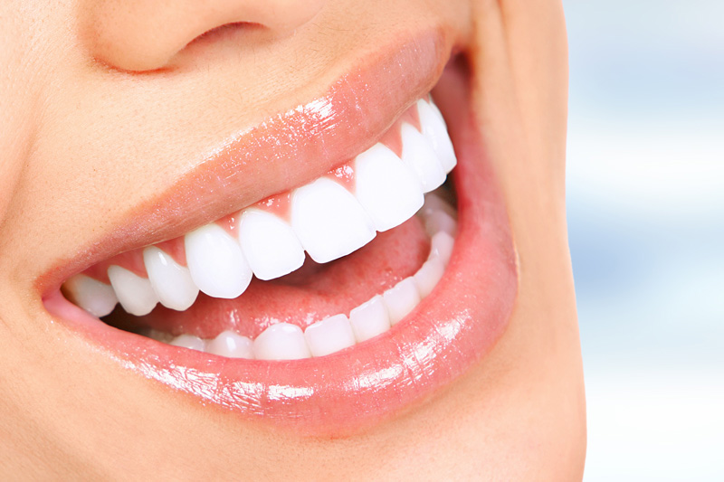 Full Smile Makeover in Orlando