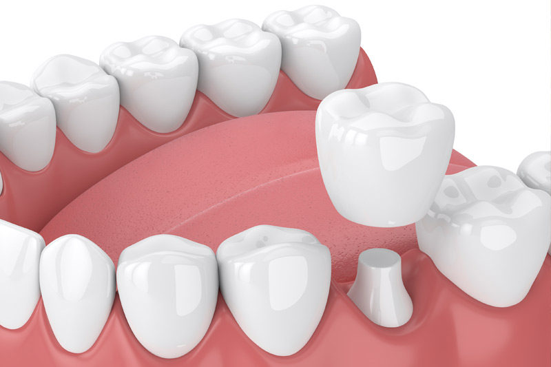 Dental Crowns in Orlando