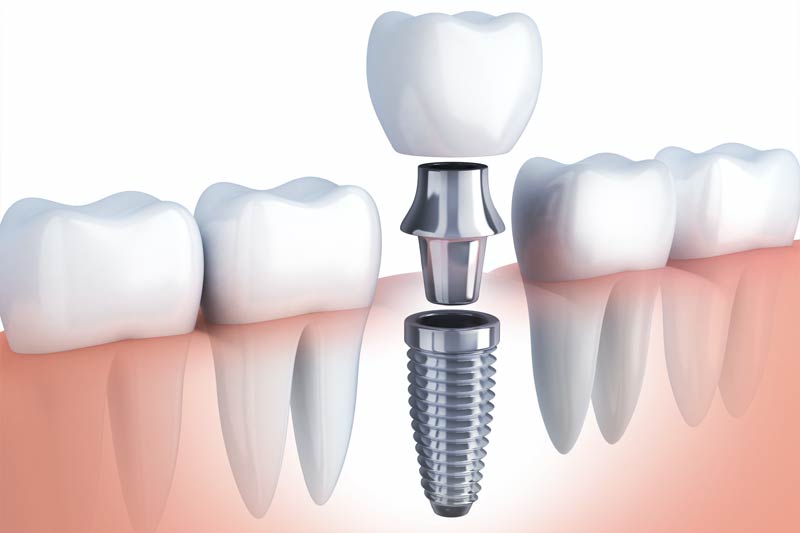 Implants Dentist in Orlando