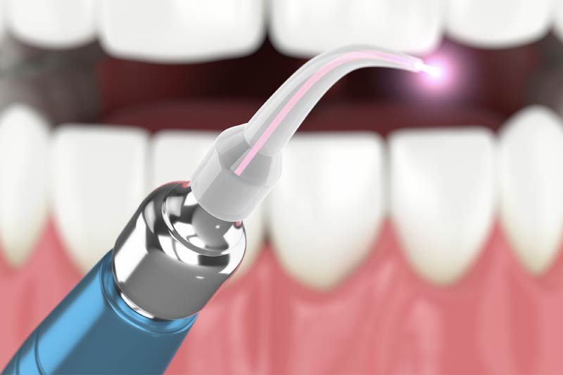 Laser Dentistry in Orlando