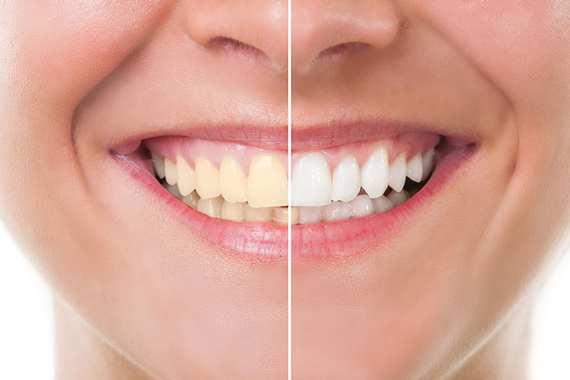 Teeth Whitening in Orlando