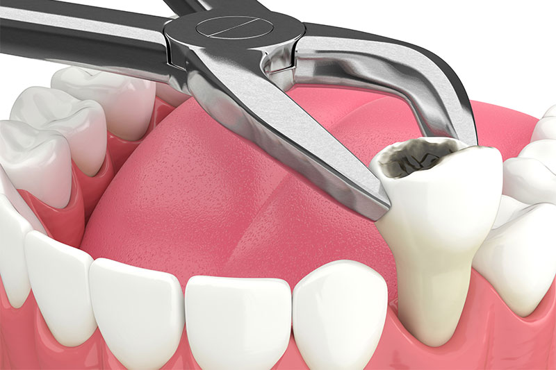 Teeth Extraction in Orlando