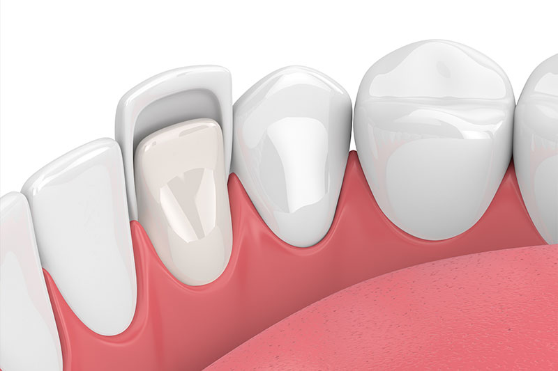 Dental Veneers in Orlando