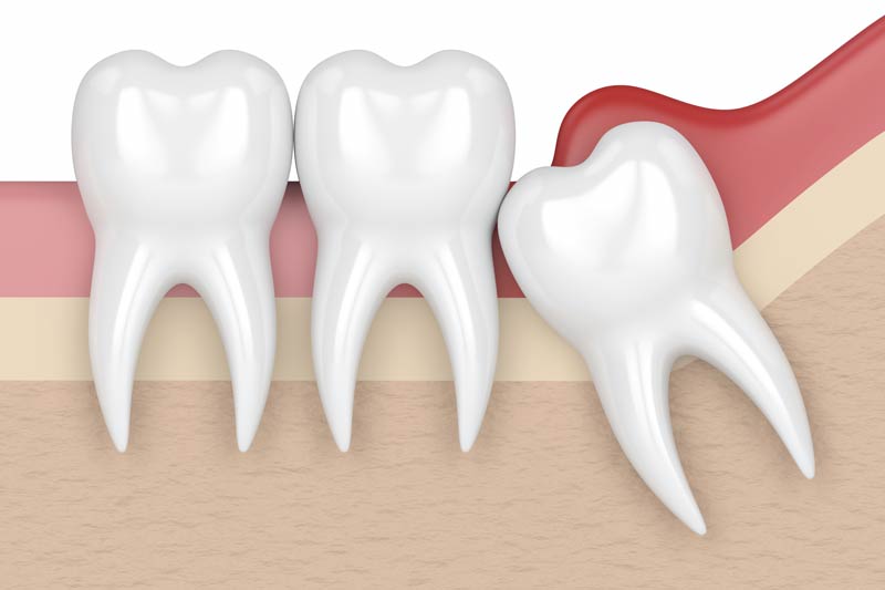 Wisdom Tooth Removal in Orlando